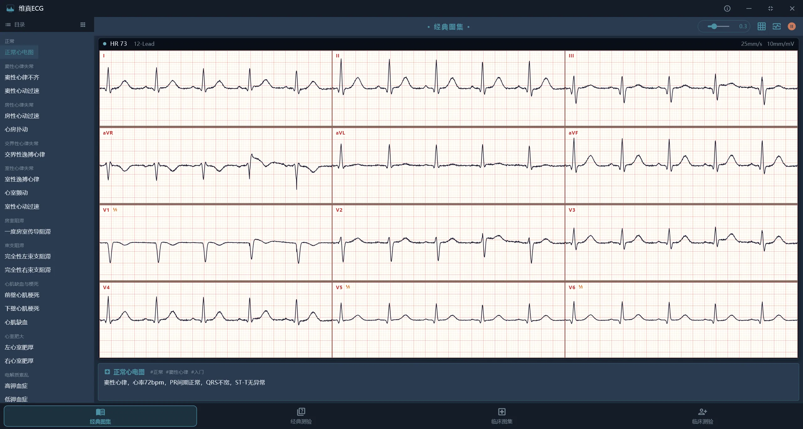 维真ECG 心电图判读学习软件